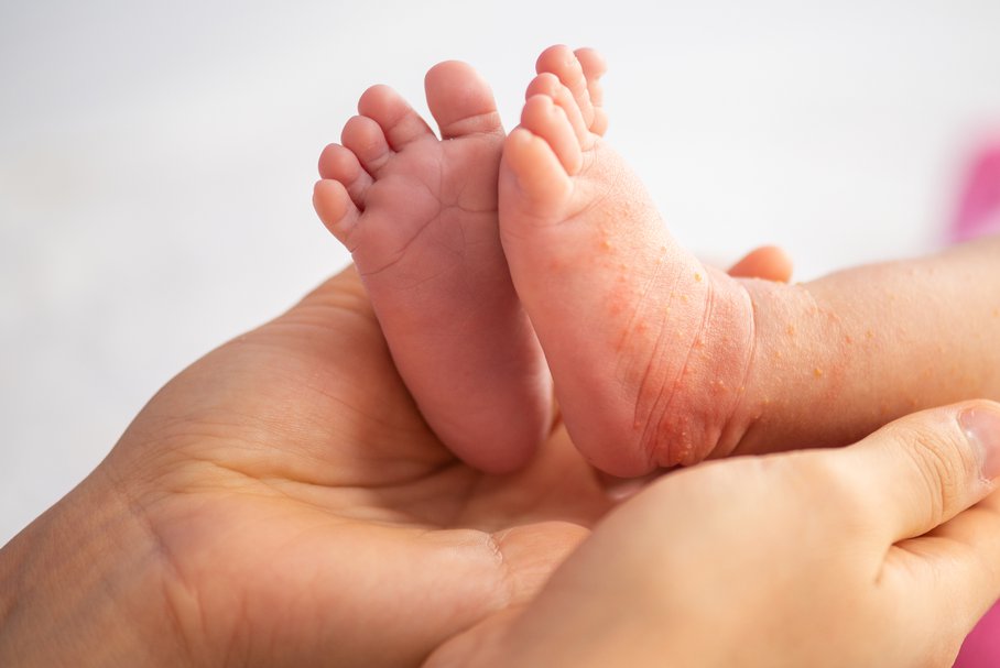 Potówki u niemowlaka – jak wyglądają? Przyczyny, leczenie, domowe sposoby na potówki u dziecka