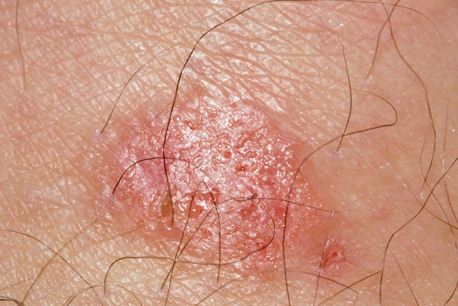 Grzybica skóry – przyczyny, objawy, leczenie i zapobieganie
