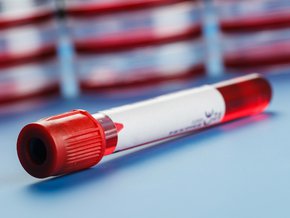 Hipertrójglicerydemia