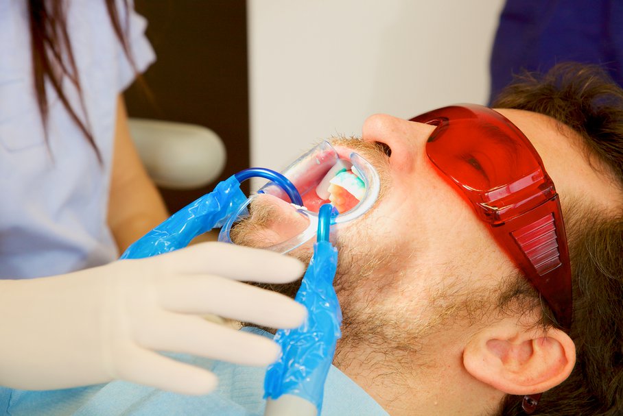 Laserowe wybielanie zębów – na czym polega, dla kogo, opinie, efekty, cena