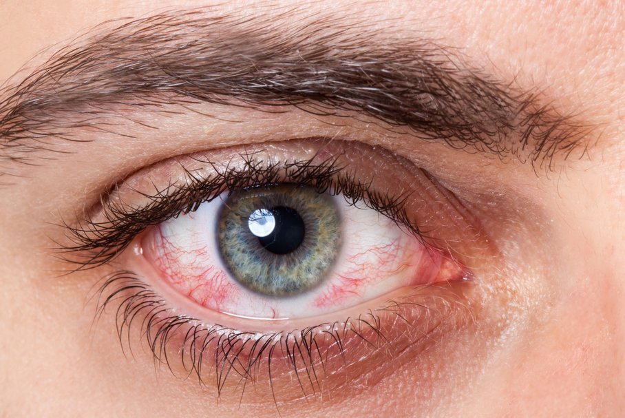 Krwistek oka – co to jest i jakie są przyczyny?