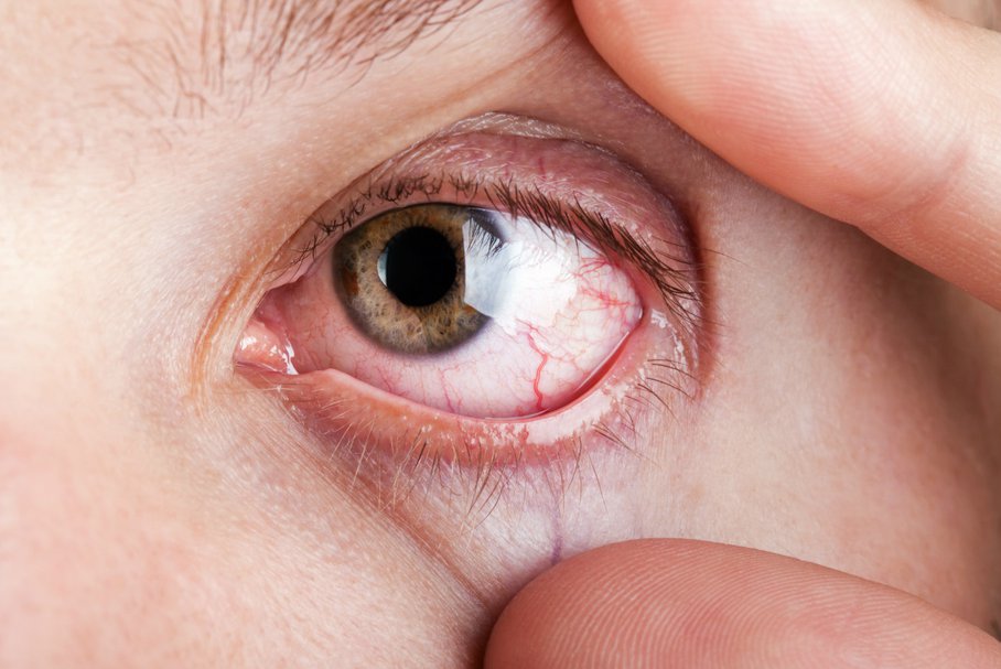 Pęknięte naczynko w oku – czego to objaw, jaka jest przyczyna i jak się leczy?