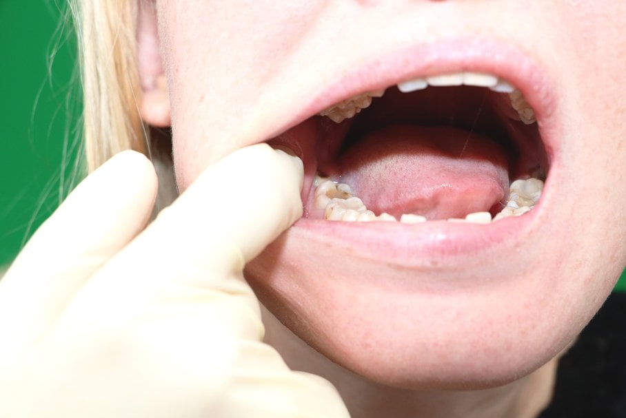 Ból ósemki – przyczyny, objawy, leczenie, domowe sposoby na ból zęba mądrości