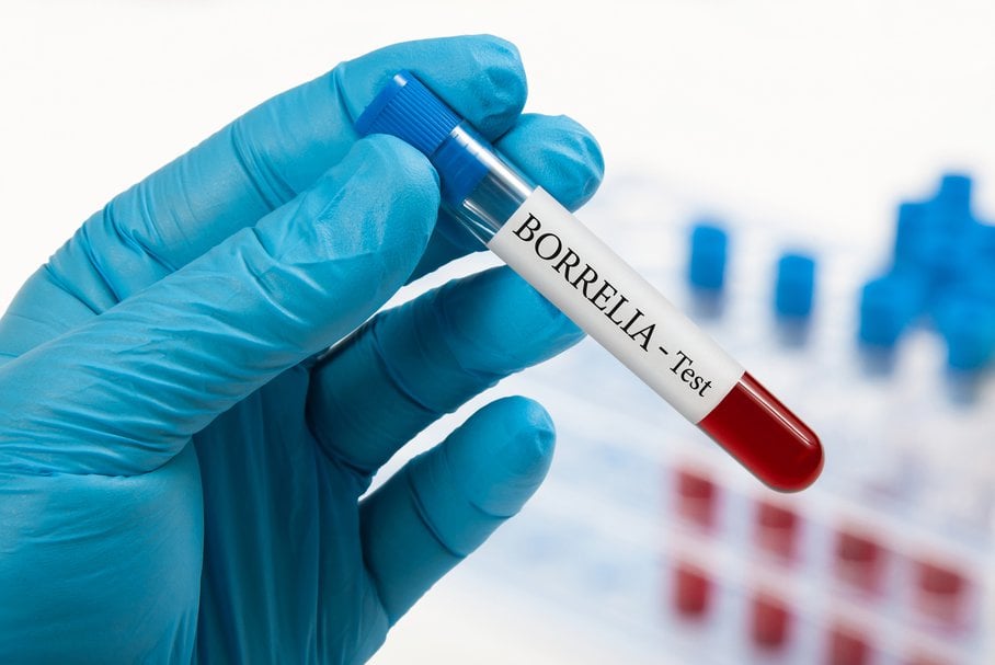 Borelioza IgM – test western blot – badanie przeciwciał IgM przeciwko boreliozie