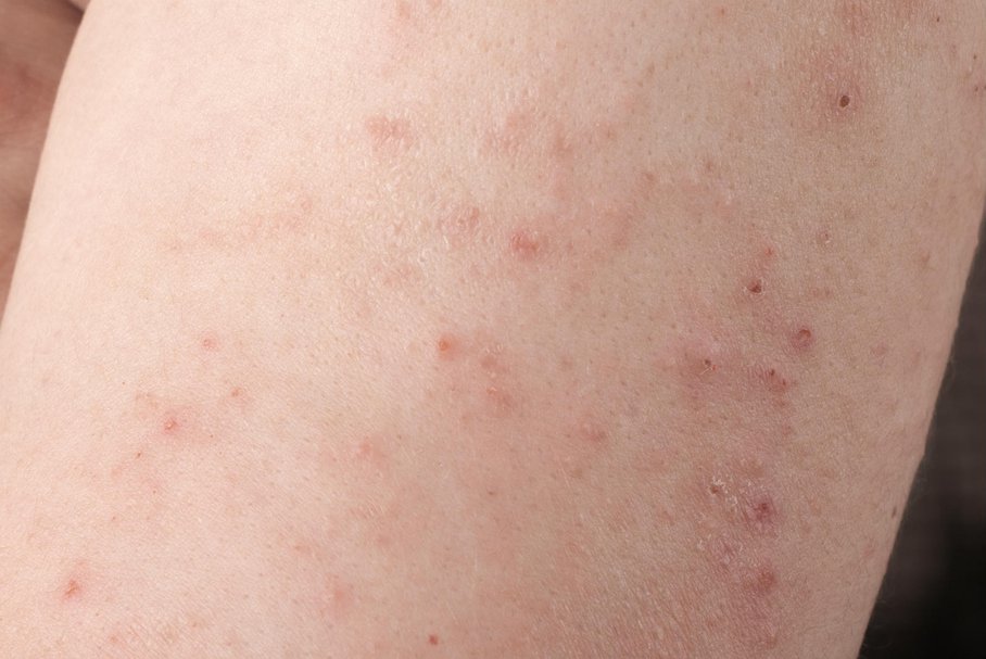 Jakie są objawy atopowego zapalenia skóry?
