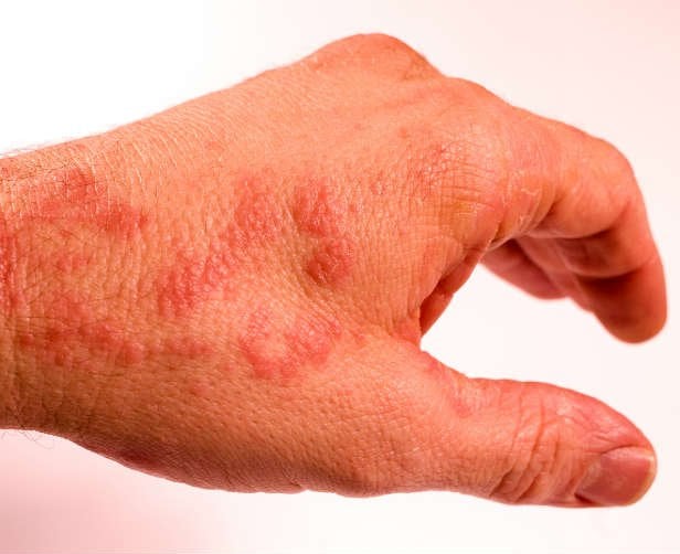 Jakie są przyczyny alergii skórnej?