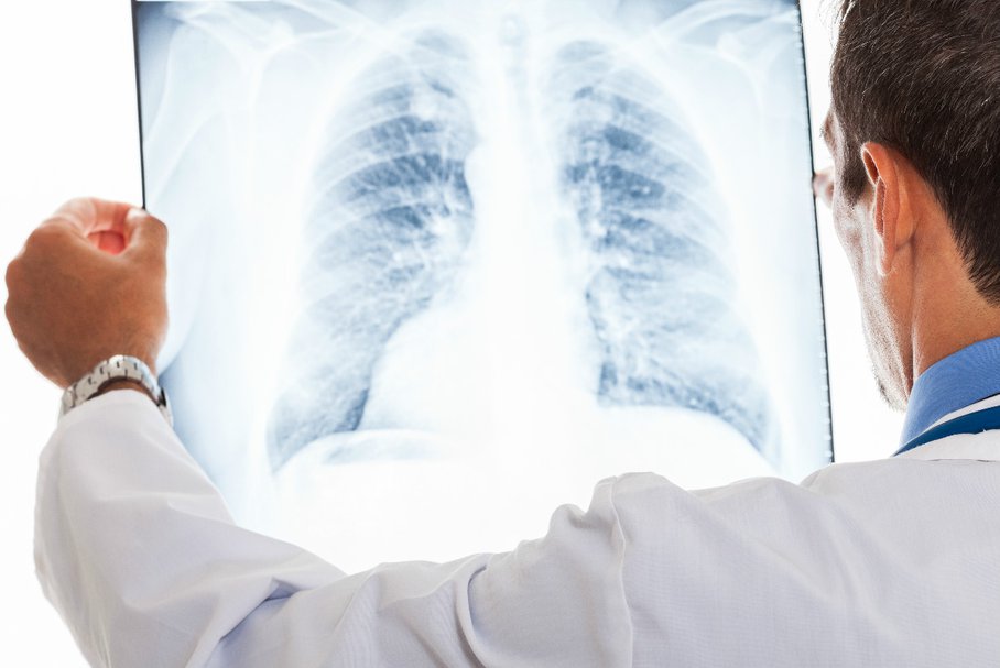 Rak płuc – badania i leczenie operacyjne