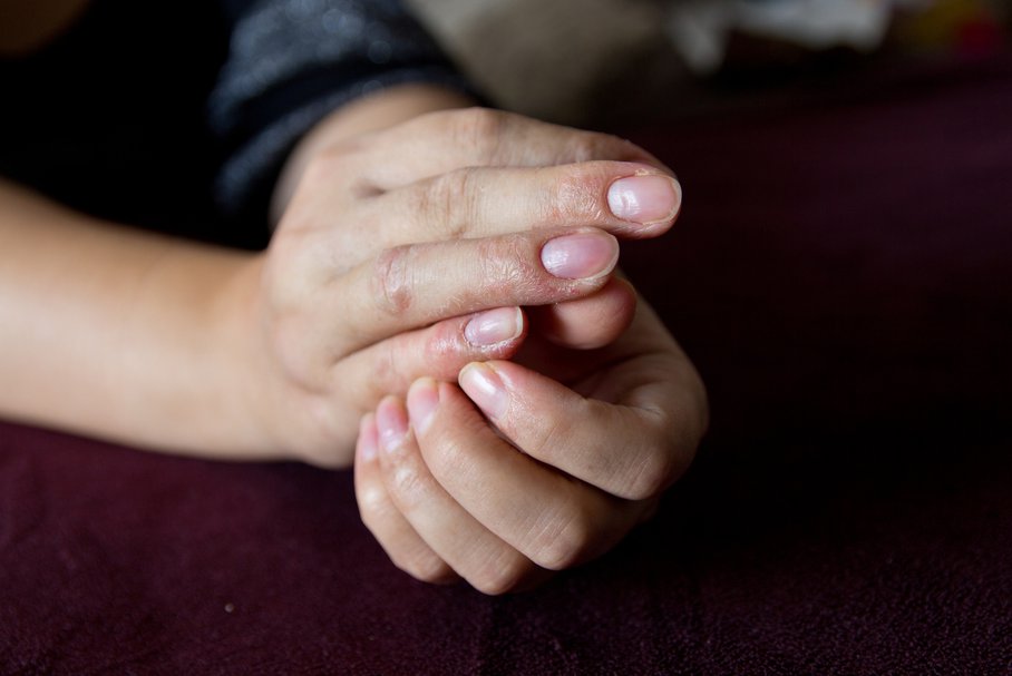 Pękająca skóra na palcach – przyczyny i sposoby na pękanie skóry palców