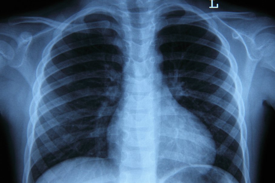 Odma płucna – przyczyny, rodzaje, objawy, badania, leczenie, powikłania