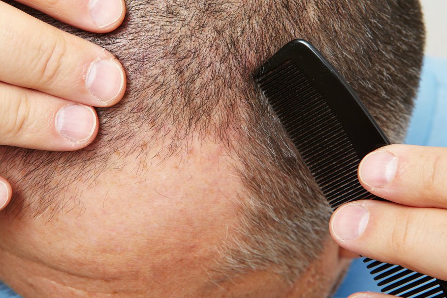 Dlaczego mężczyźni łysieją? Jakie są przyczyny łysienia u mężczyzn?