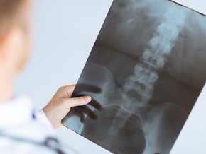 Złamanie kręgosłupa – objawy, leczenie, powikłania i rokowanie