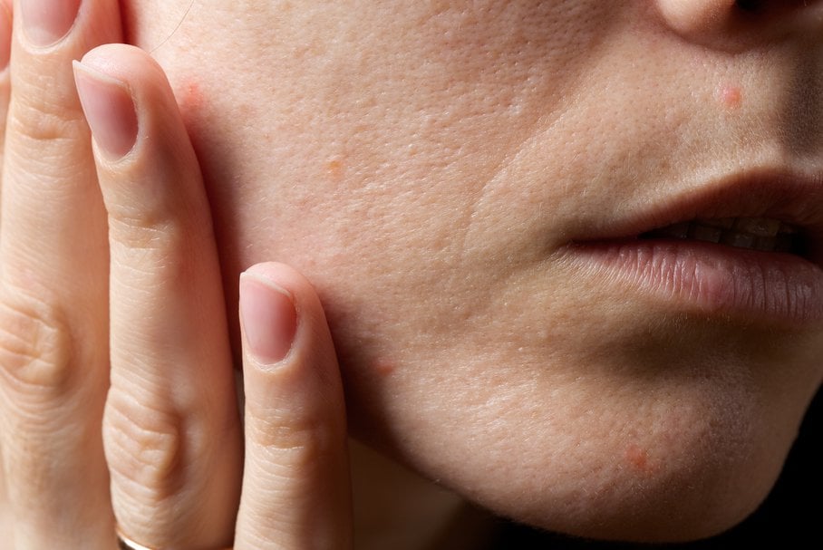 Pokrzywka na twarzy – przyczyny, rodzaje, objawy, leczenie