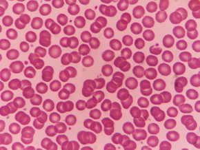 Jak leczyć anemię aplastyczną
