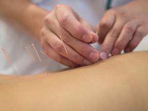 suche igłowanie, igłoterapia
