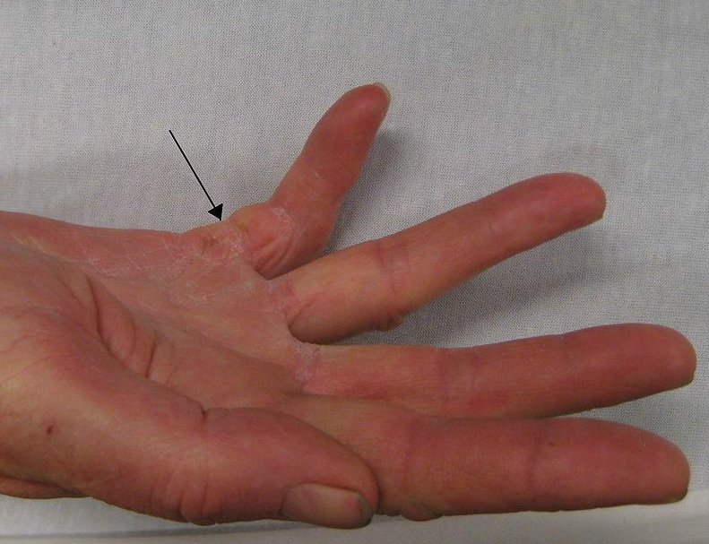 Drętwienie i mrowienie dłoni – przyczyny, diagnostyka, leczenie