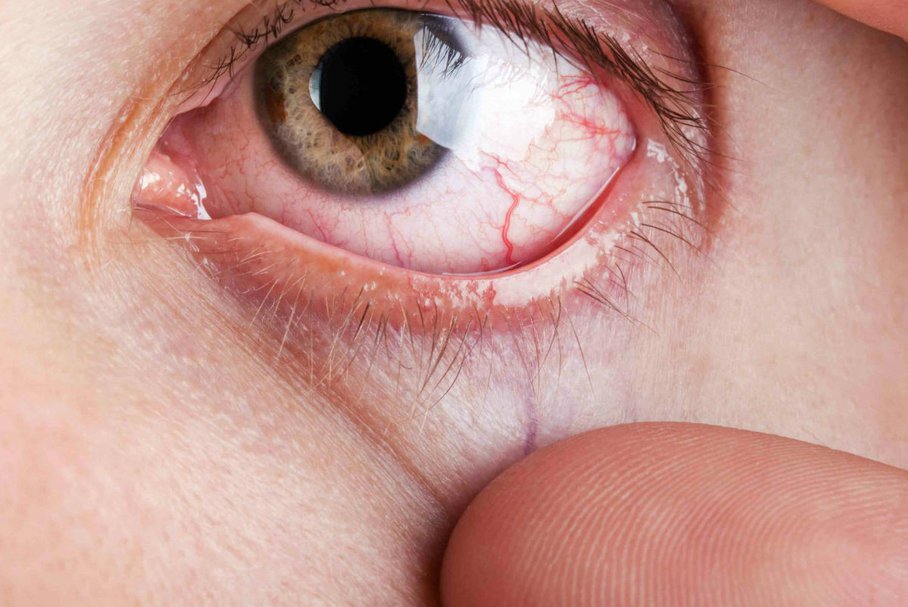Podkrążone oczy – przyczyny i sposoby na podkrążone oczy