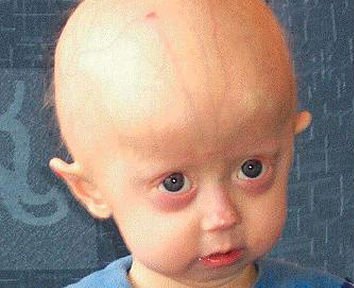 Progeria (Syndrom Hutchinsona-Gilforda)