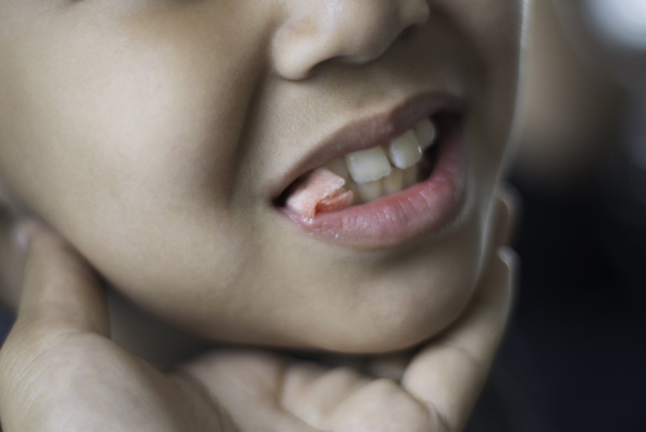 Ból po wyrwaniu zęba – ile trwa, jak pozbyć się bólu po usunięciu zęba?
