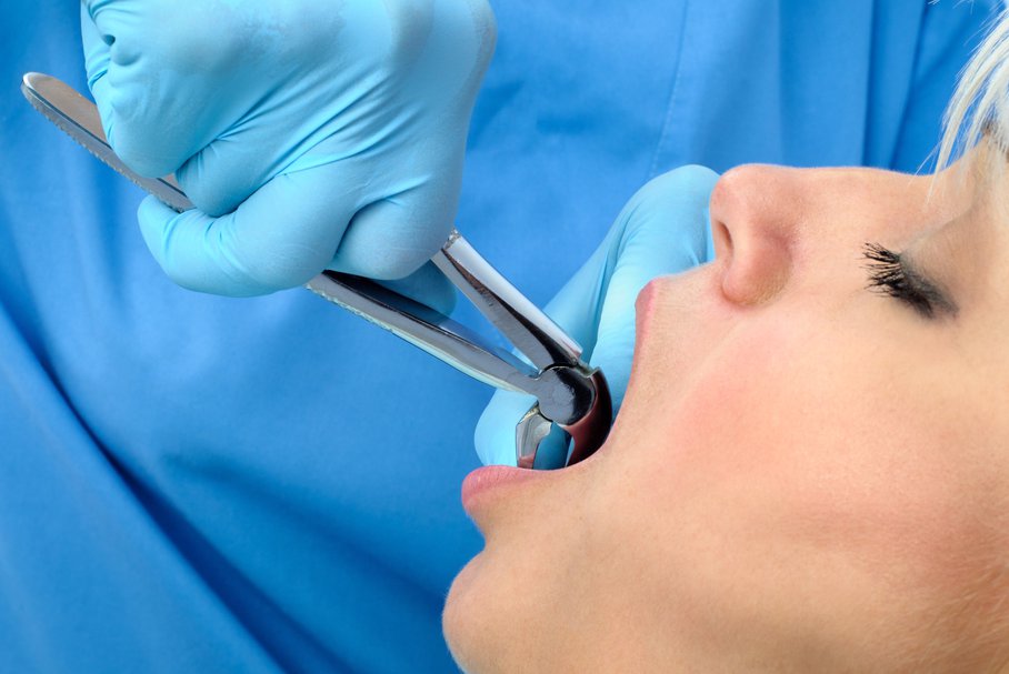 Skrzep po wyrwaniu zęba, rana po ekstrakcji – ile się utrzymuje?