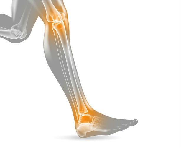 Gęsia stopa – przyczyny, objawy, badania, leczenie, ćwiczenia, zapobieganie gęsiej stópce
