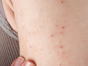 Atopowe zapalenie skóry u dzieci – przyczyny, objawy, leczenie