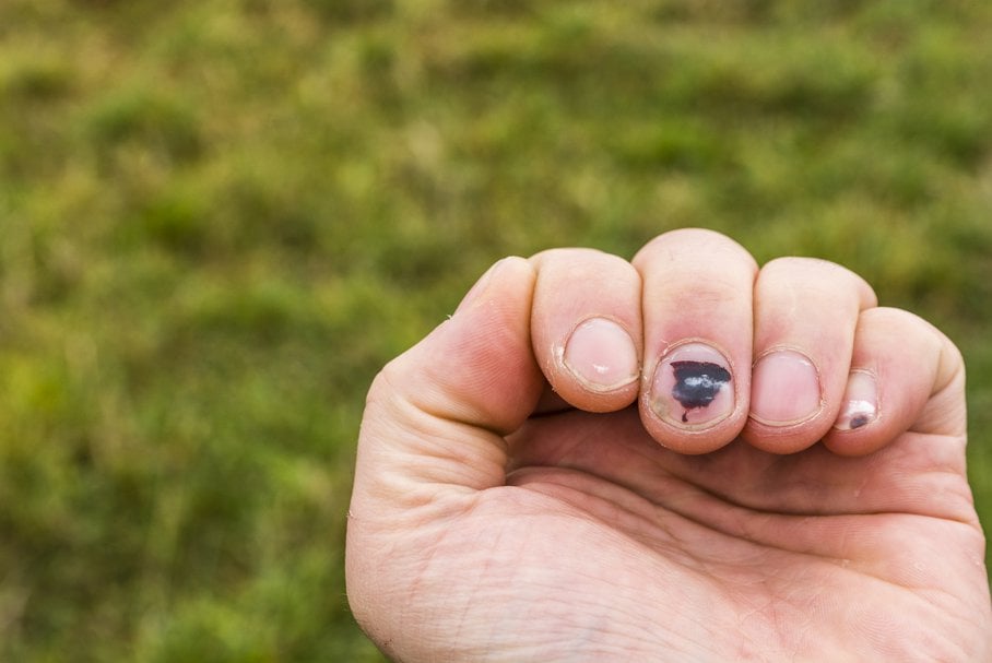 Czarne paznokcie – przyczyny, objawy, rozpoznanie