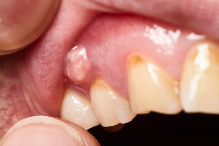 Przetoka zębowa – przyczyny, objawy, leczenie