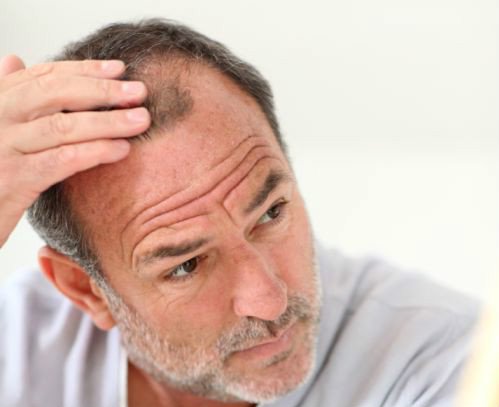 Wypadanie włosów u mężczyzn – przyczyny i leczenie