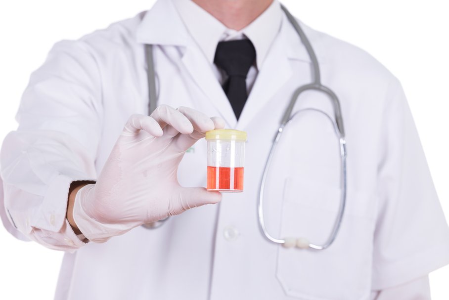 Lekarz trzymający próbkę moczu z krwią.