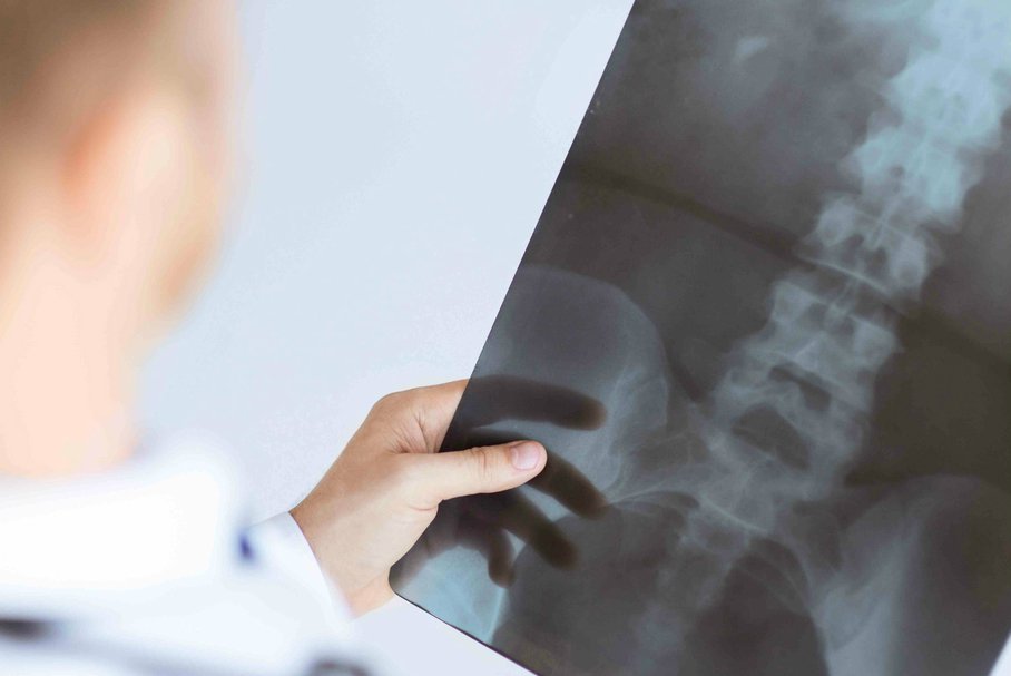 Jak zapobiegać osteoporozie?