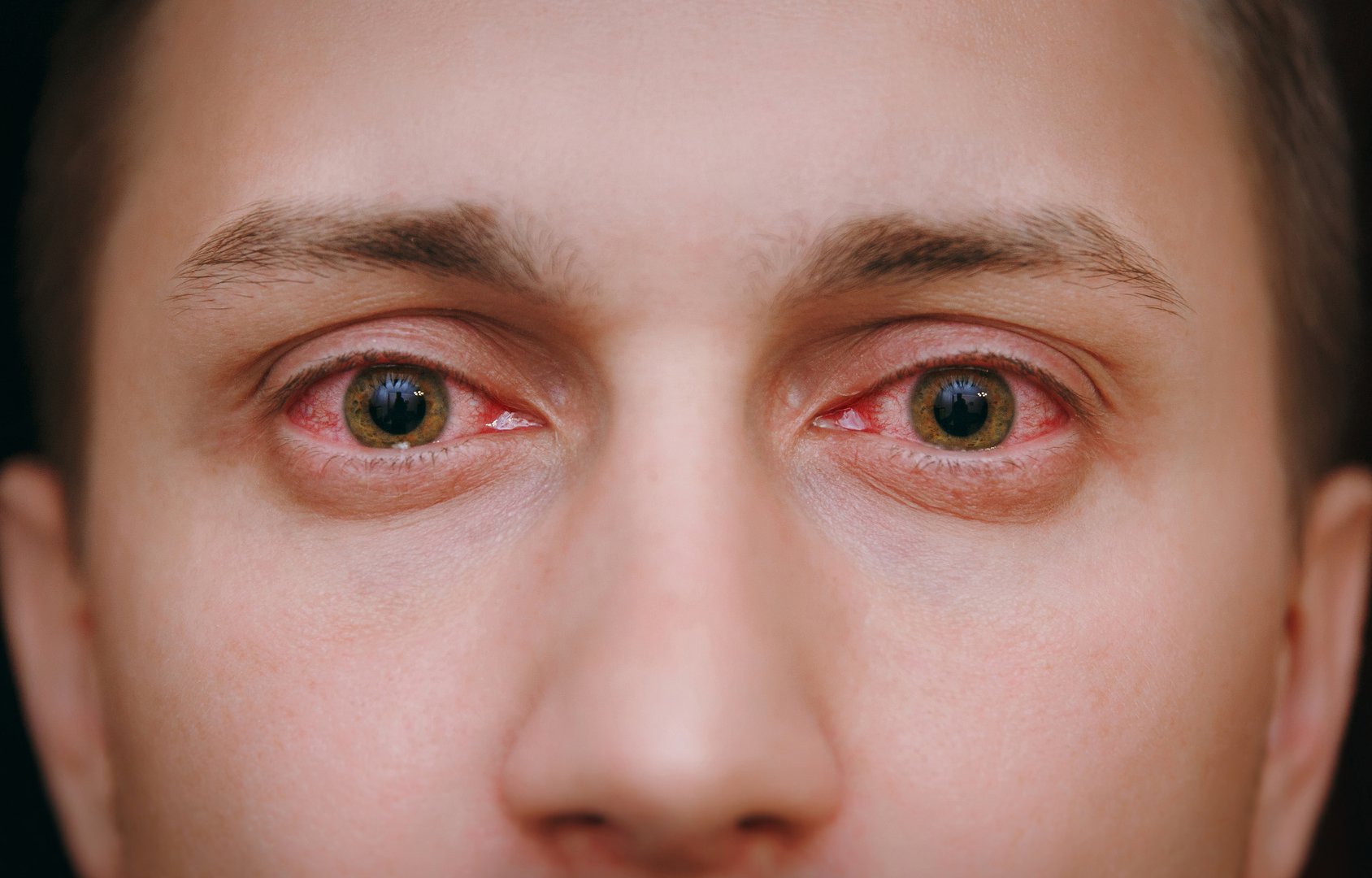 Czerwone Oczy Przyczyny Sposoby Leczenie Czerwonych Oczu Wyleczto 6350