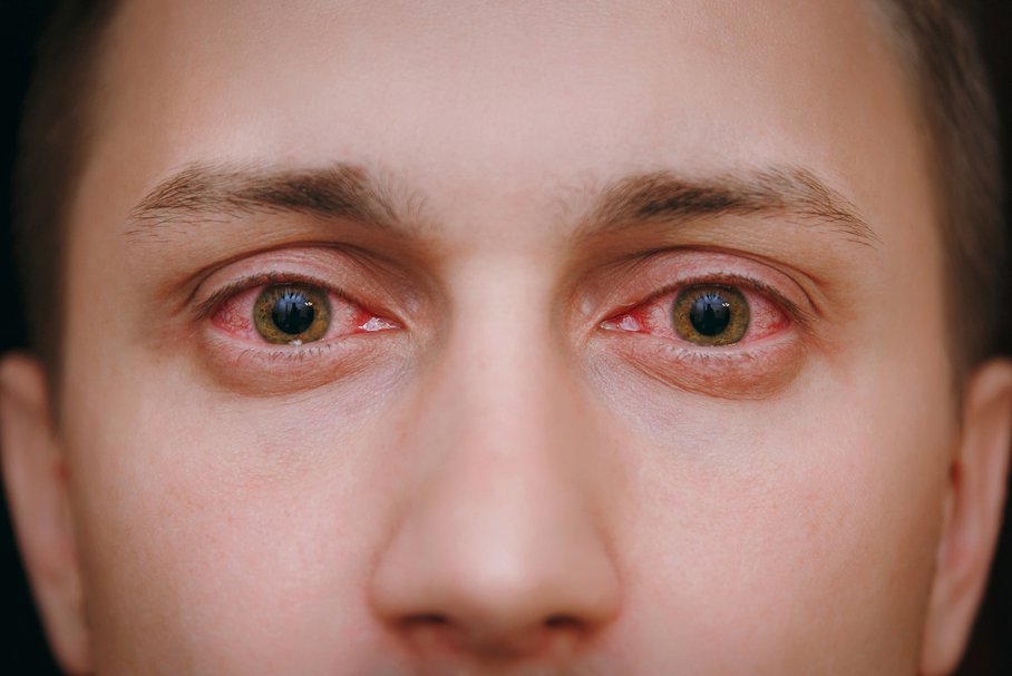Czerwone Oczy Przyczyny Sposoby Leczenie Czerwonych Oczu Wylecz To