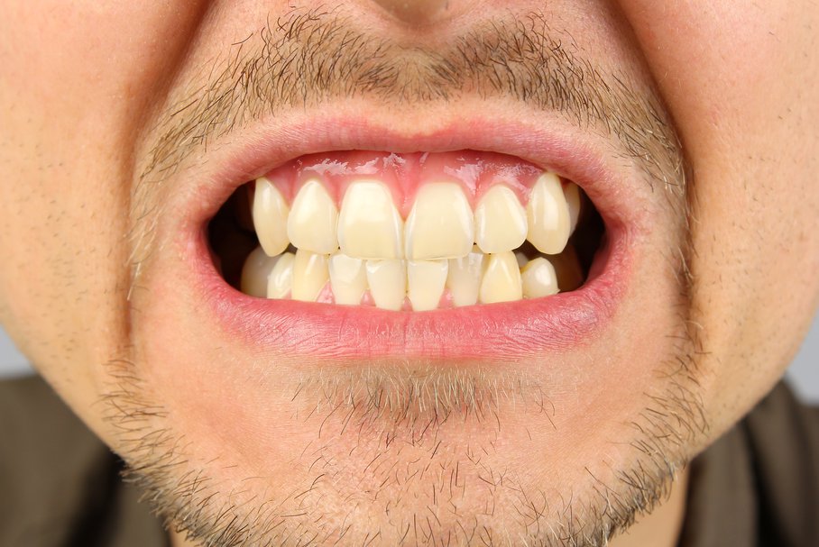 Wybielanie martwego zęba – jakie są metody i domowe sposoby na wybielanie zęba martwego?