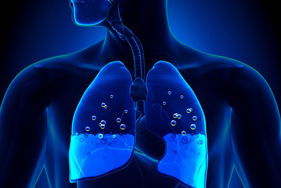 Woda w płucach – jakie są przyczyny, jak się pozbyć, czy jest wyleczalna, jakie są rokowania?