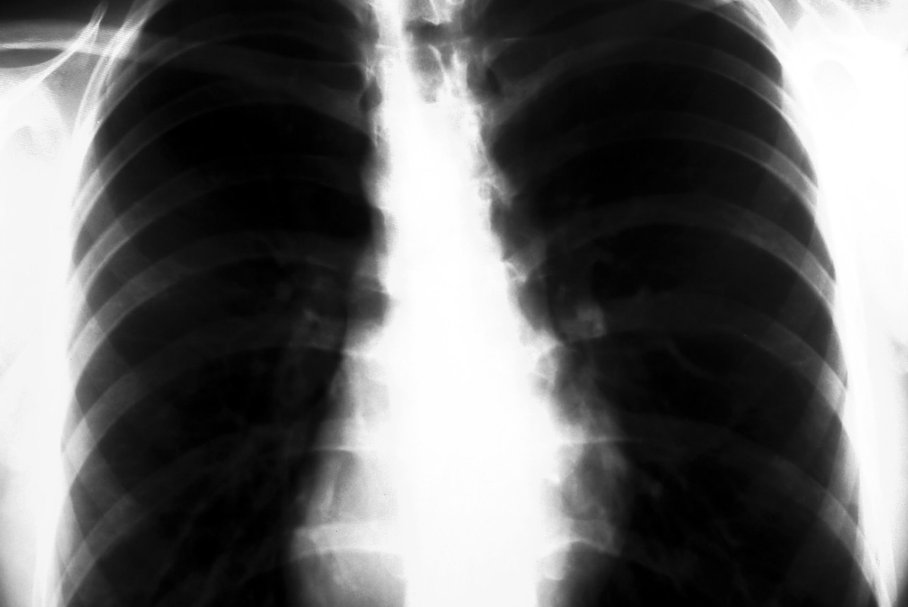 Zapalenie płuc po grypie – co to jest i jak się leczy grypowe zapalenie płuc?