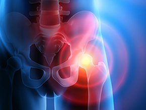 Złamania osteoporotyczne – najczęstsze złamania kości w osteoporozie