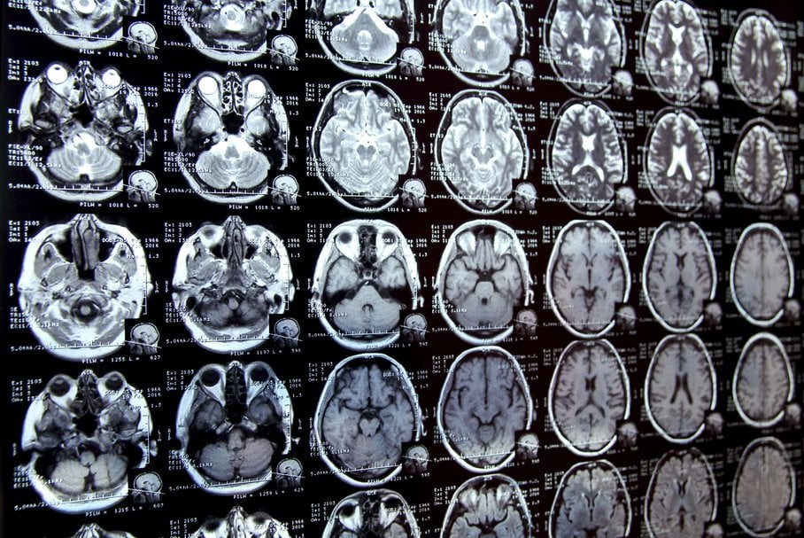 Niedotlenienie mózgu – objawy, skutki, leczenie