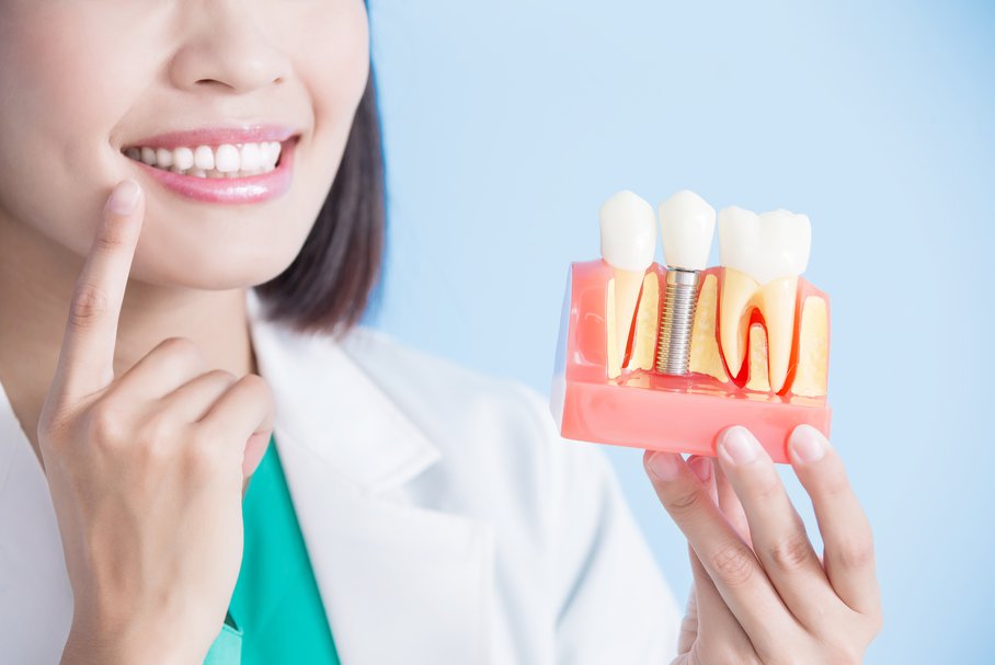 Implanty zębowe – czym są, jak się je zakłada, rodzaje