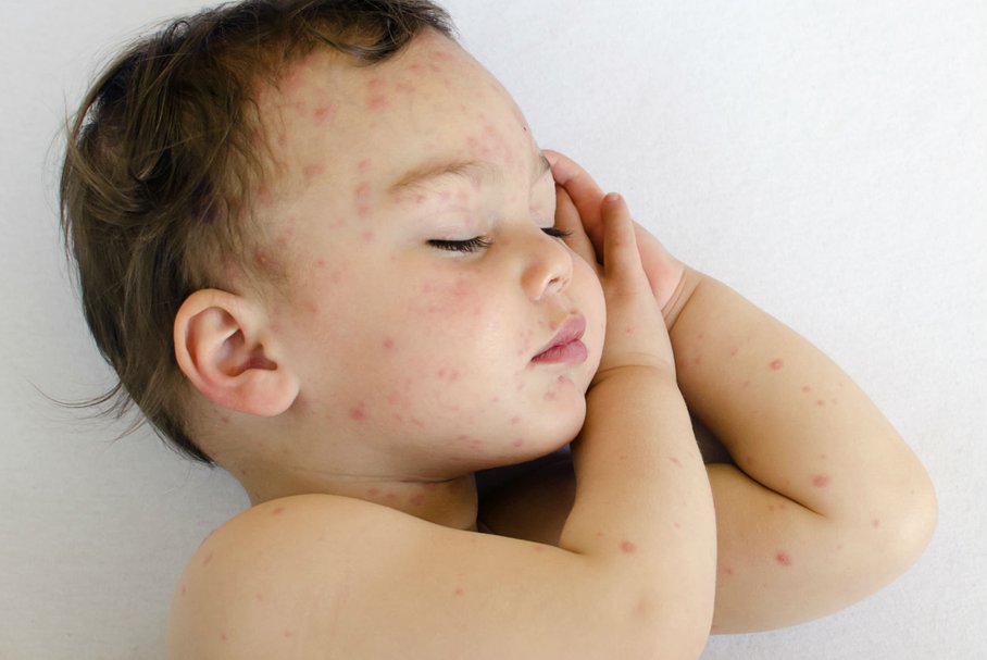 Łojotokowe zapalenie skóry u niemowląt – przyczyny, objawy, leczenie