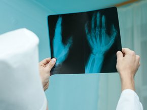 Złamania kości śródręcza – przyczyny, objawy, leczenie