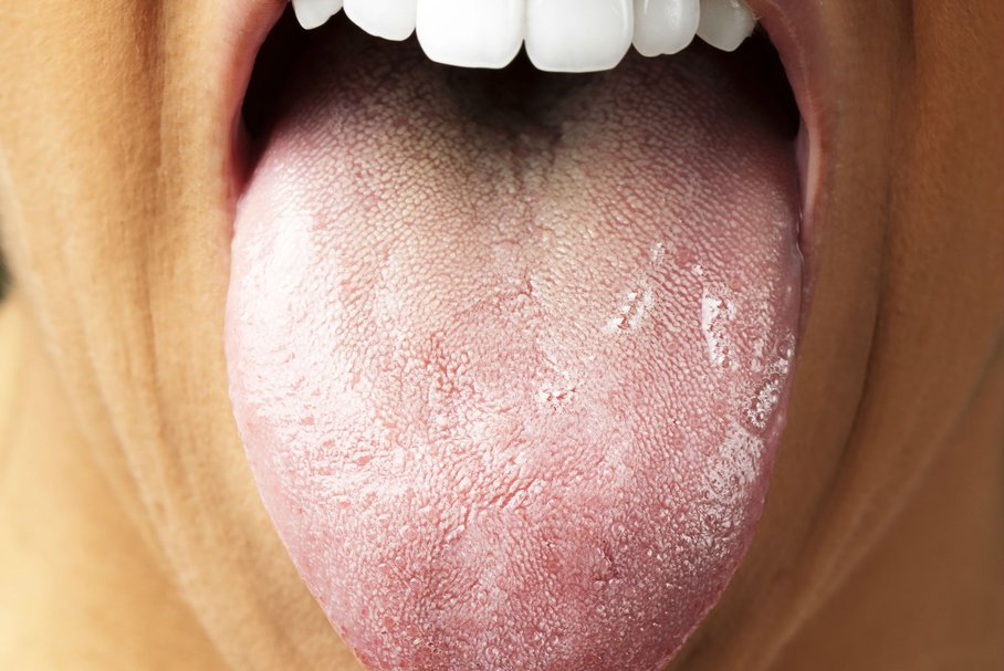 Grzybica jamy ustnej – przyczyny, objawy i leczenie
