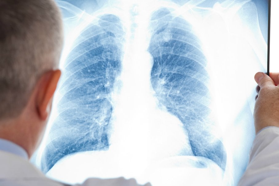 Lkearz oglądający zdjęcie rentgenowskie płuc.