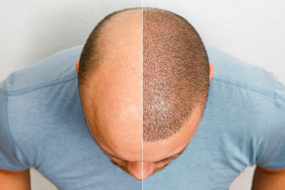 Mężczyzna przed i po zabiegu przeszczepu włosów.