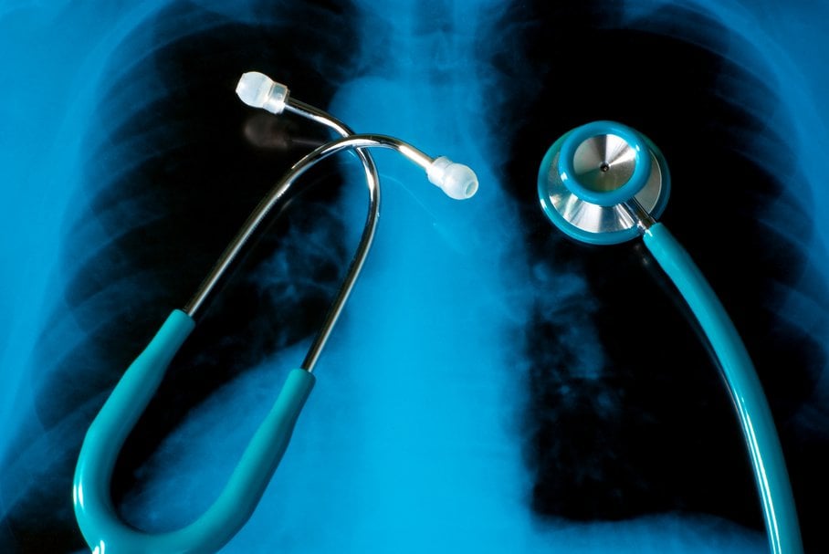 Cienie na płucach – owalne, krągłe – czy zacienienie w RTG to rak płuca?