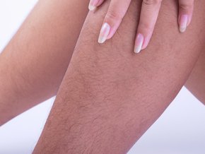 hiperandrogenizm