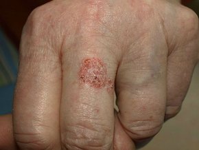 Choroba Bowena – przyczyny, objawy, leczenie, rozpoznanie, rokowania