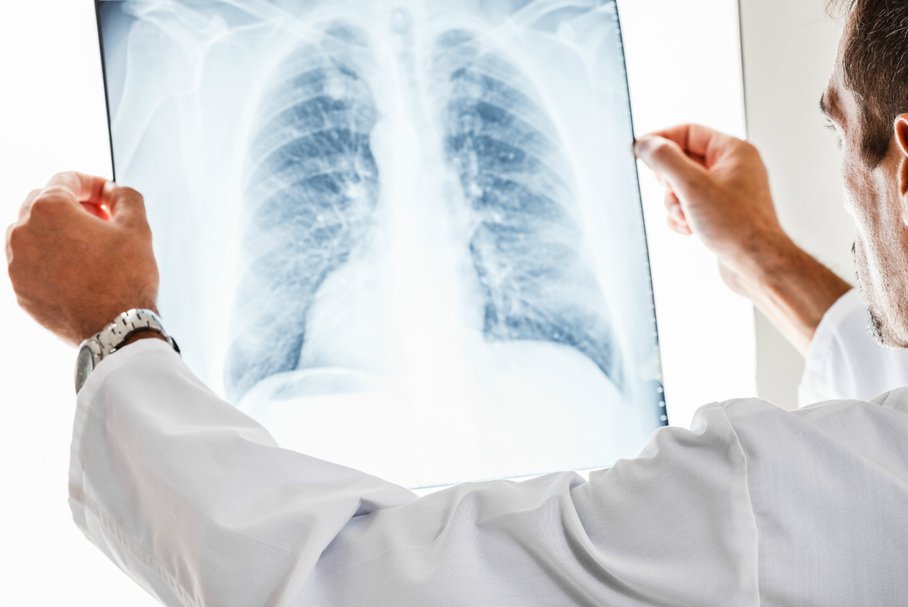 Grzybica płuc – przyczyny, objawy, leczenie, rokowania