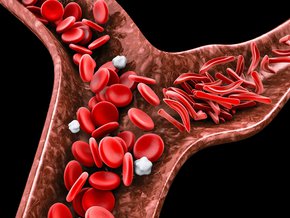 anemia sierpowata