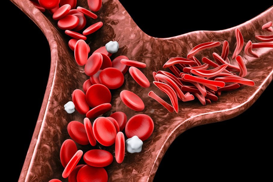 anemia sierpowata
