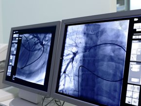 Zespół żyły głównej górnej – przyczyny, objawy, badania i leczenie
